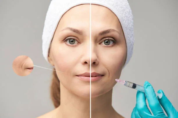 Acne Scar treatment in Chennai