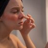 Acne Scar treatment in Chennai