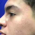 Acne Scar treatment in Chennai Acne Scar treatment in Chennai