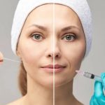 Acne Scar treatment in Chennai Acne Scar treatment in Chennai