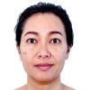 image-before-after-spot-melasma-260nw-2085606328 (1)